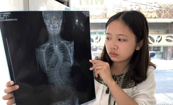 安徽网:大三女生励志上学 脊柱侧弯成"s"形为手术费犯愁
